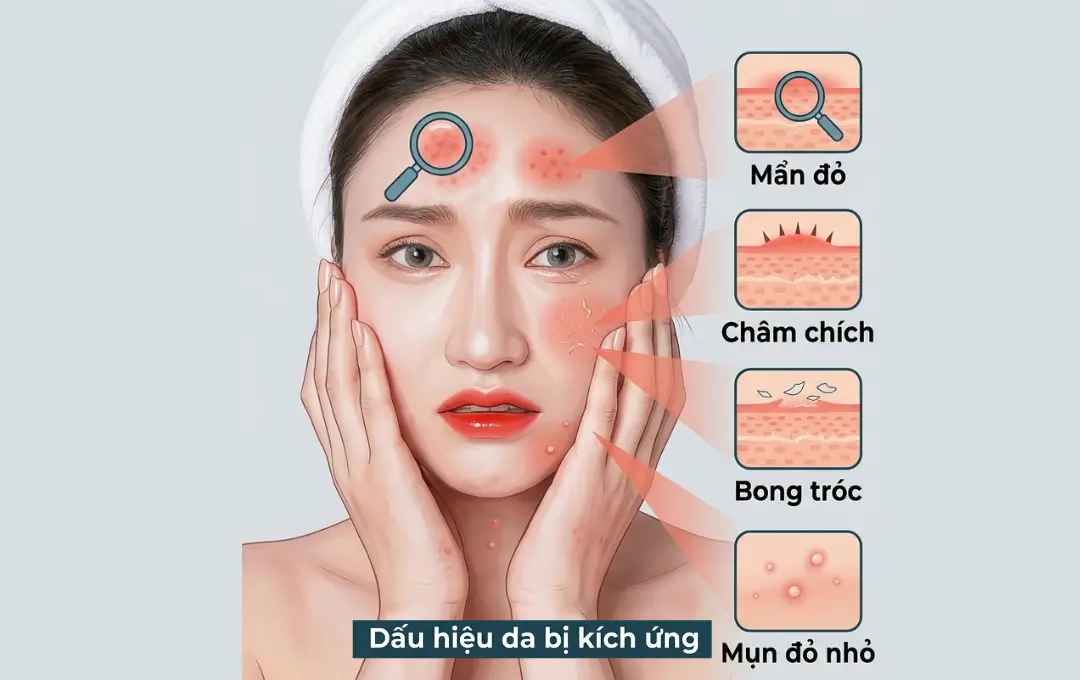 3 Lầm tưởng lớn về kem dưỡng ẩm - Skincare 2 dau-hieu-cua-da-bi-kich-ung-1080x680px